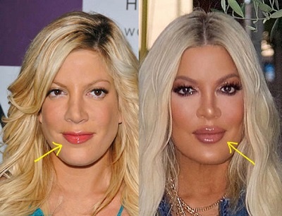 Tori Spelling Chirurgie Esth Tique R V Lations De Chirurgiens