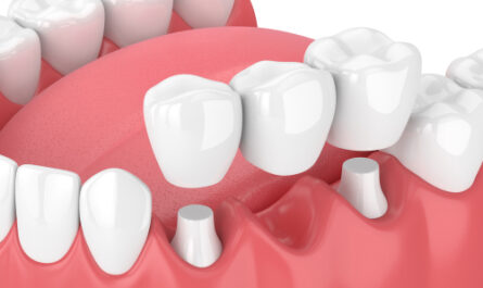 alternative-implant-dentaire