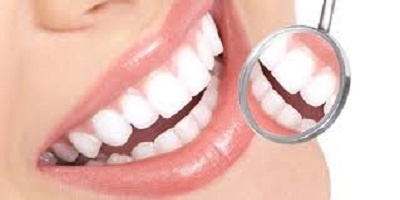 Guide facette dentaire pour une dentition esthétique