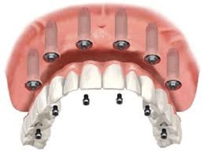 prix implants all on 6 tunisie